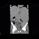Myeloproliferative disorder, skeletal changes, splenomegally, artifact from failed detector: CT - Computed tomography